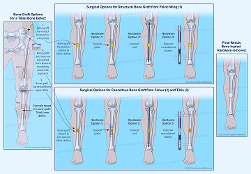 Bone Grafting | International Center for Limb Lengthening